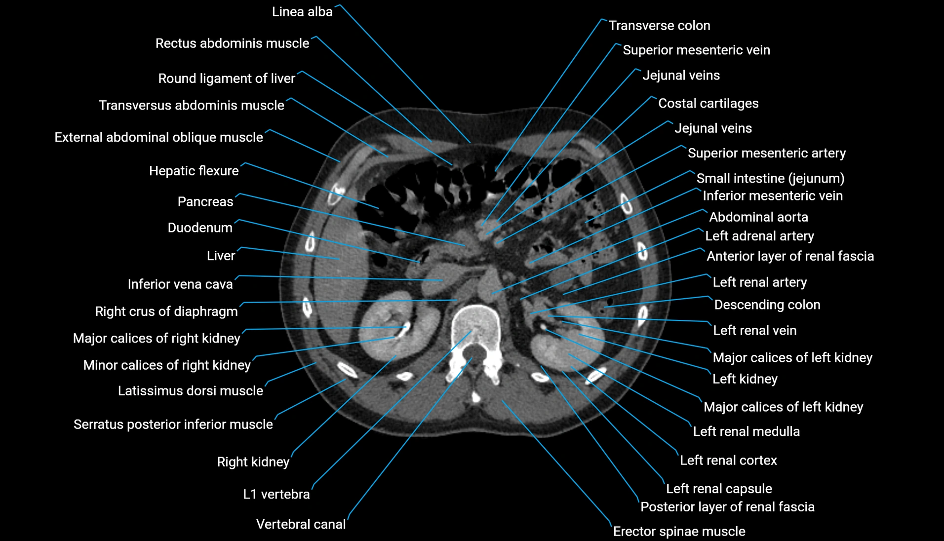 CT urogram axial cross sectional anatomy  labelled radiology image-00095.webp